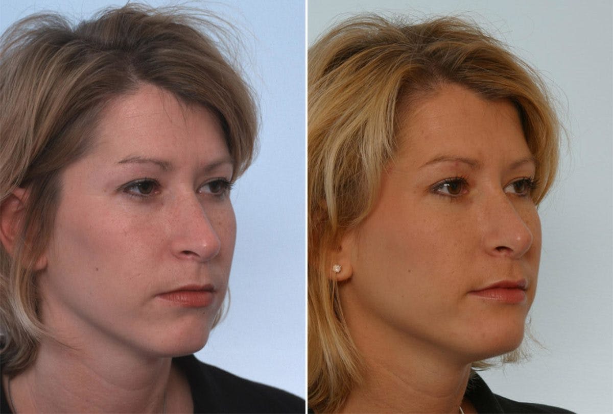 Rhinoplasty Before & After Gallery - Patient 55171290 - Image 3