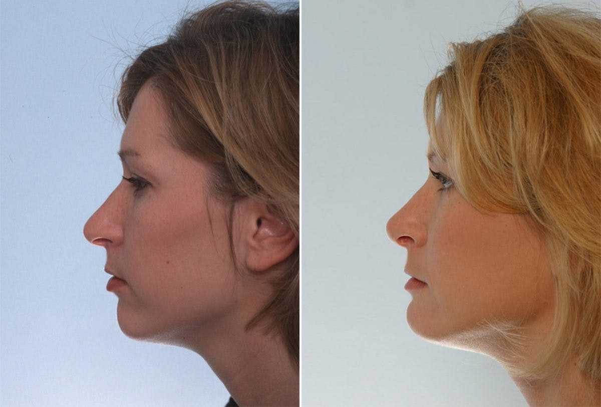 Rhinoplasty Before & After Gallery - Patient 55171290 - Image 2