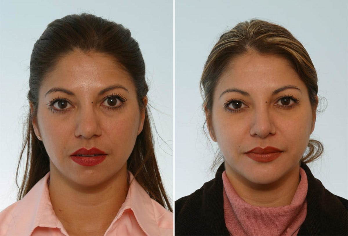 Rhinoplasty Before & After Gallery - Patient 55171291 - Image 1