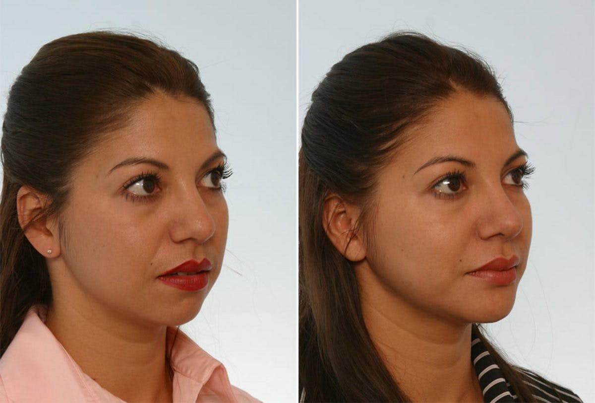 Rhinoplasty Before & After Gallery - Patient 55171291 - Image 3