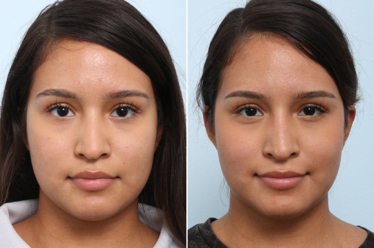 Non-Surgical Rhinoplasty Before & After Gallery - Patient 55171292 - Image 1