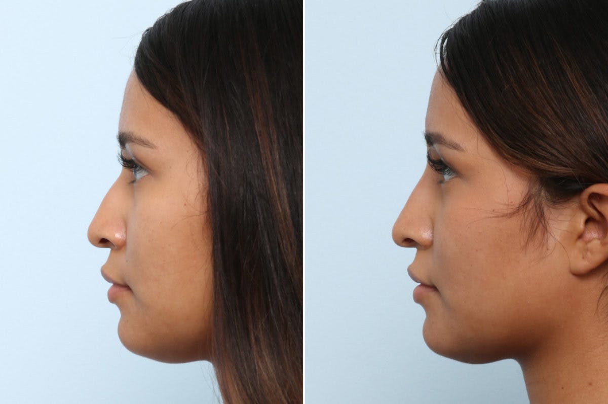 Non-Surgical Rhinoplasty Before & After Gallery - Patient 55171292 - Image 2