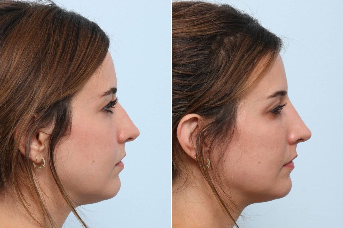 Non-Surgical Rhinoplasty Before & After Gallery - Patient 55171293 - Image 2