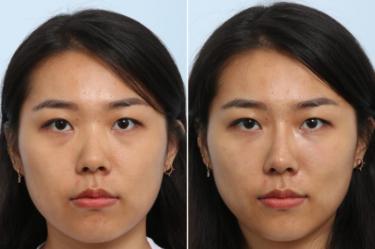 Non-Surgical Rhinoplasty Before & After Gallery - Patient 55171294 - Image 1