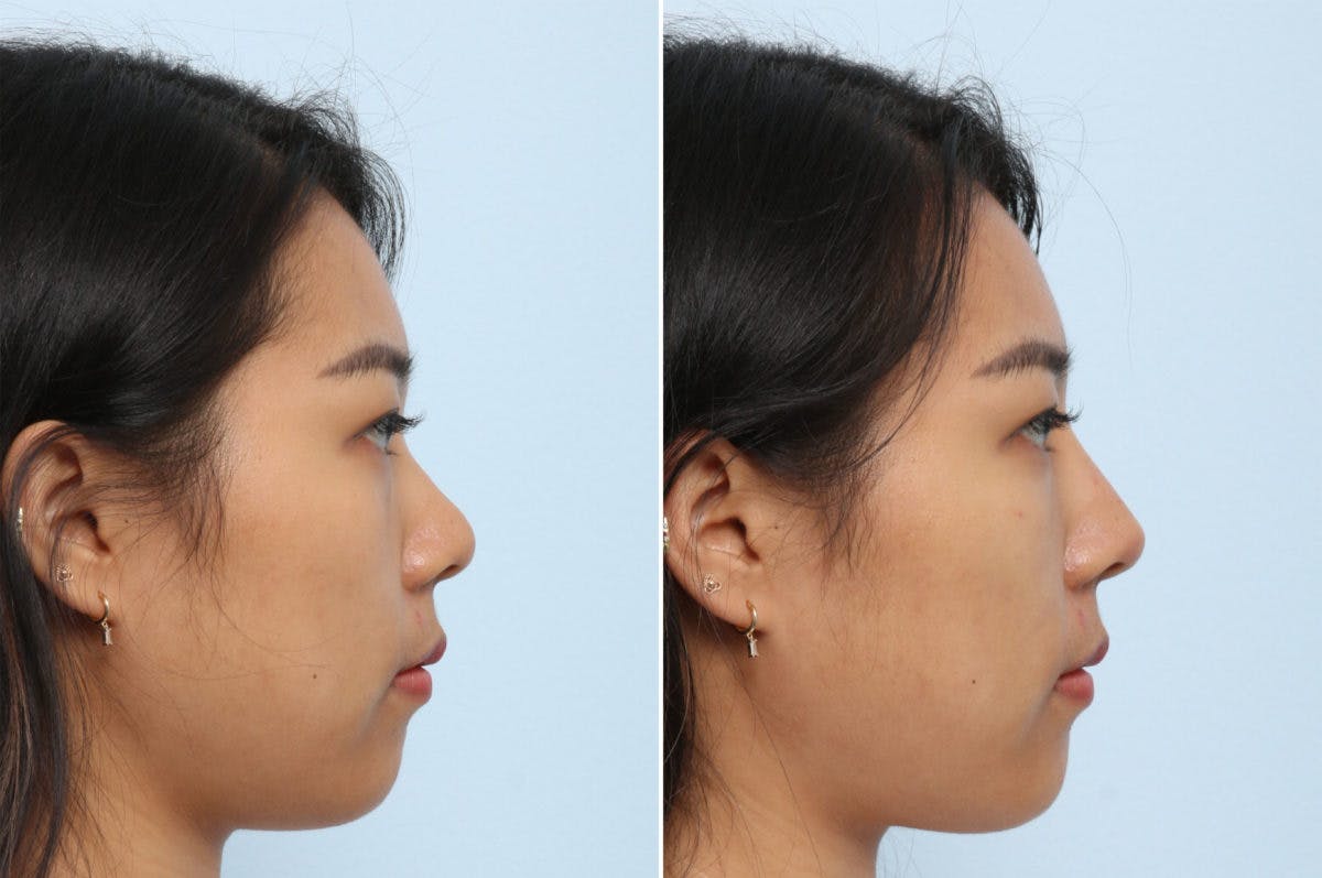 Non-Surgical Rhinoplasty Before & After Photo - Patient 55171294 - Image 2