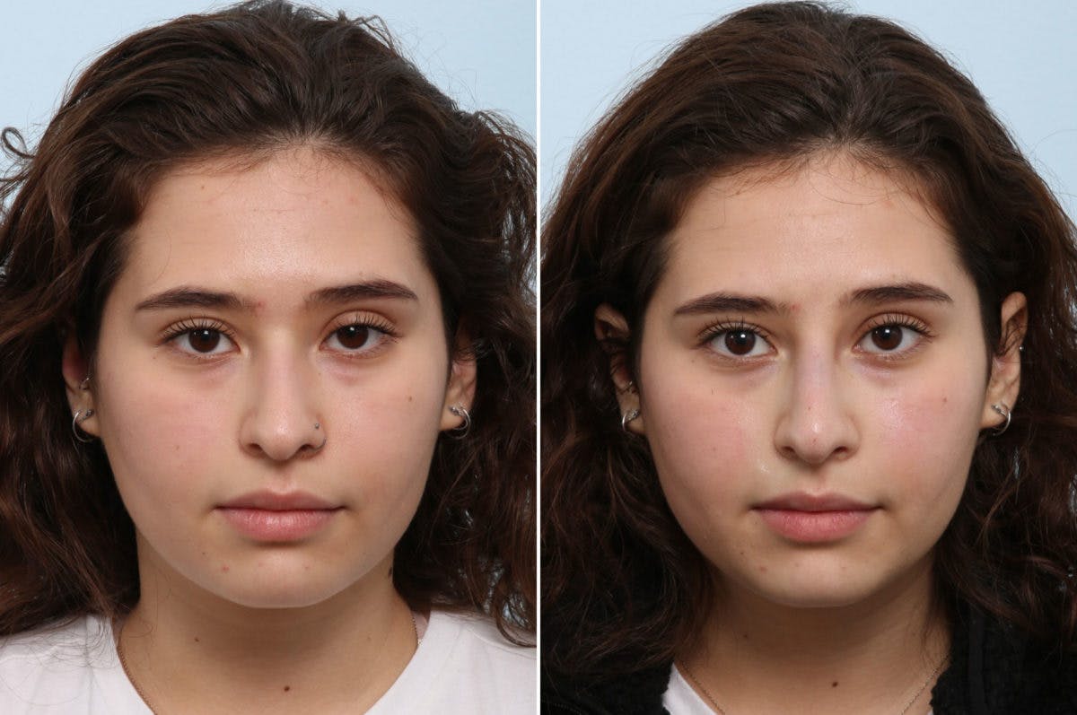 Non-Surgical Rhinoplasty Before & After Gallery - Patient 55171295 - Image 1