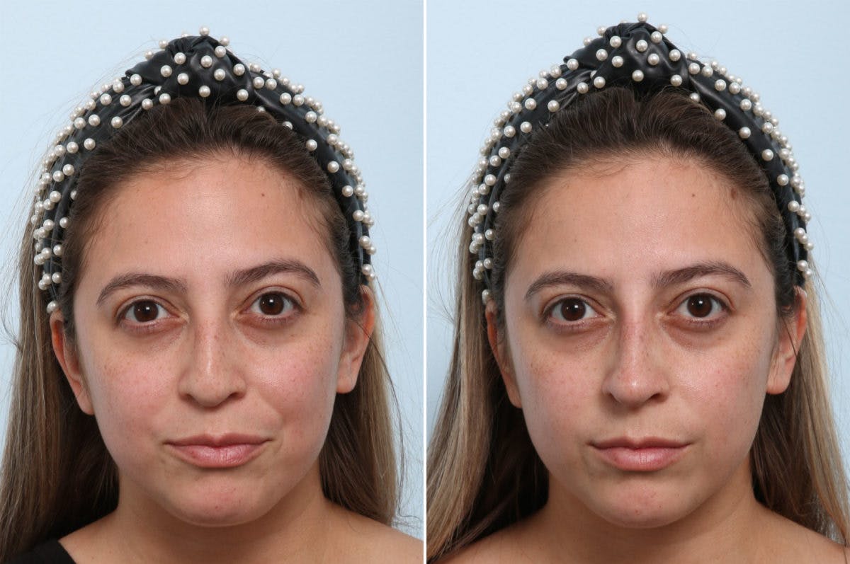 Non-Surgical Rhinoplasty Before & After Gallery - Patient 55171296 - Image 1