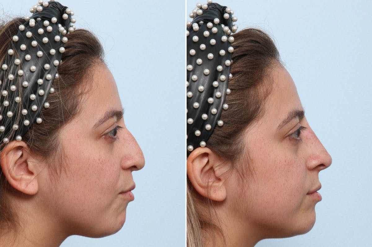 Non-Surgical Rhinoplasty Before & After Gallery - Patient 55171296 - Image 2