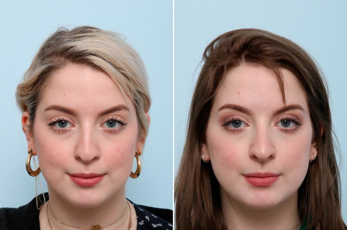 Non-Surgical Rhinoplasty Before & After Gallery - Patient 55171299 - Image 1