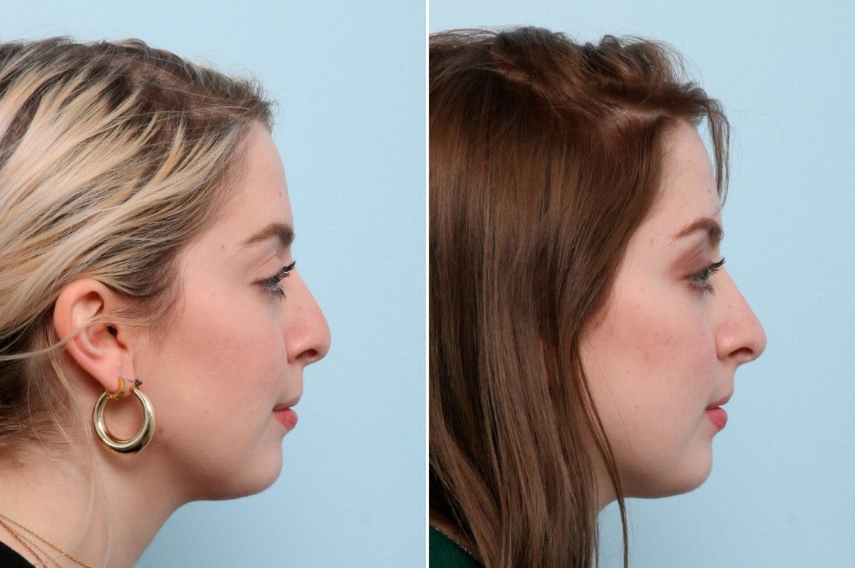 Non-Surgical Rhinoplasty Before & After Gallery - Patient 55171299 - Image 2