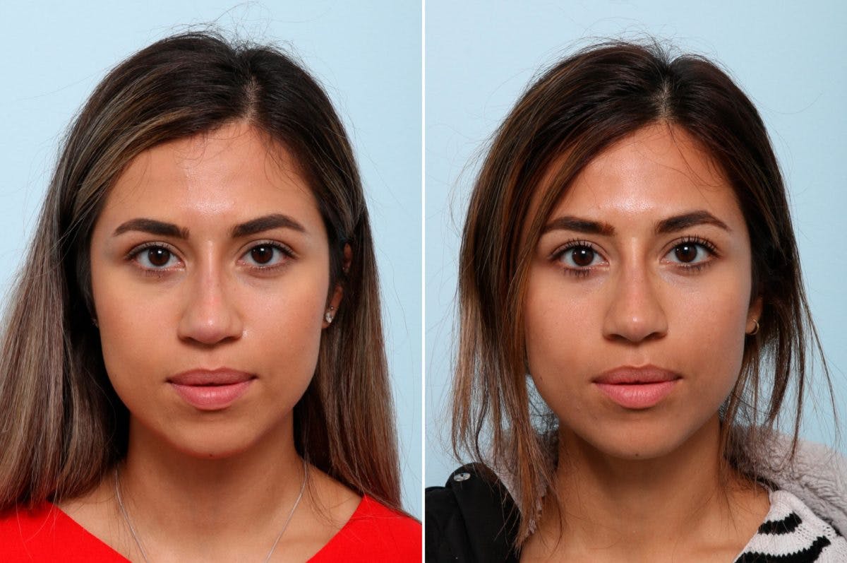 Non-Surgical Rhinoplasty Before & After Gallery - Patient 55171301 - Image 1