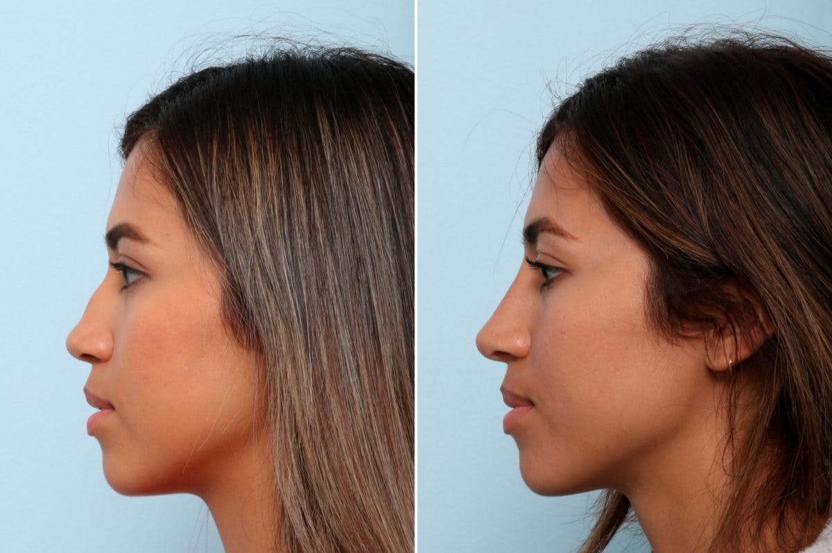 Non-Surgical Rhinoplasty Before & After Gallery - Patient 55171301 - Image 2