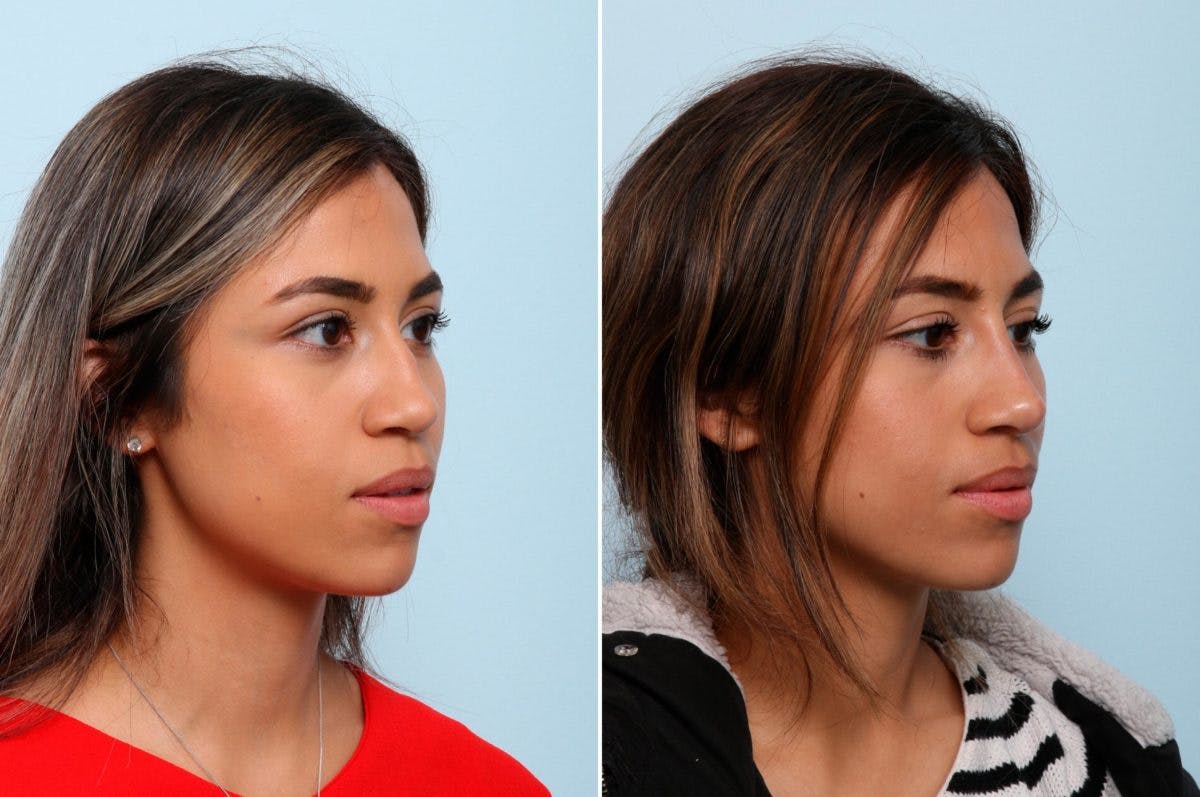 Non-Surgical Rhinoplasty Before & After Gallery - Patient 55171301 - Image 3