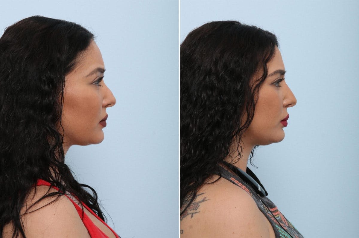 Non-Surgical Rhinoplasty Before & After Gallery - Patient 55171303 - Image 2