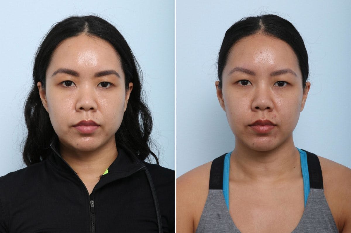 Non-Surgical Rhinoplasty Before & After Photo - Patient 55171304 - Image 1