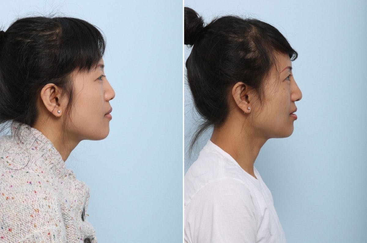 Non-Surgical Rhinoplasty Before & After Photo - Patient 55171305 - Image 2