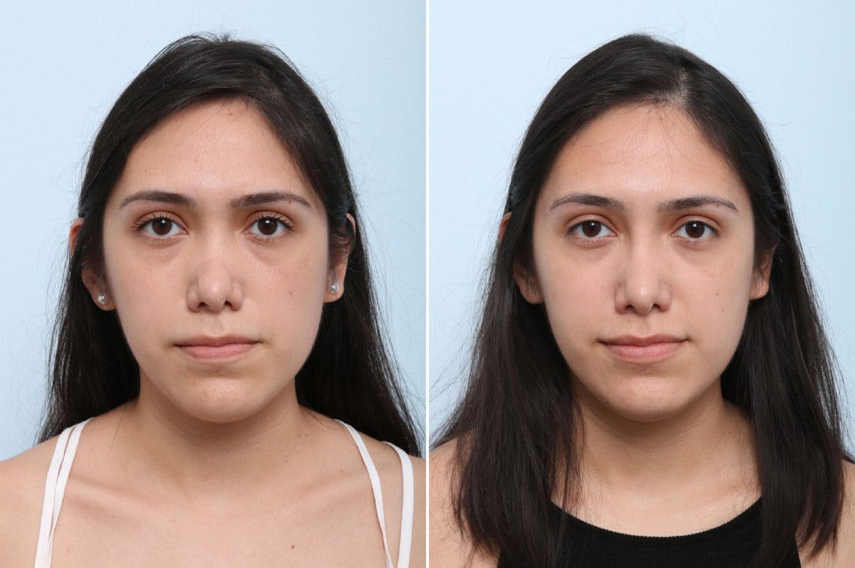 Non-Surgical Rhinoplasty Before & After Gallery - Patient 55171306 - Image 1