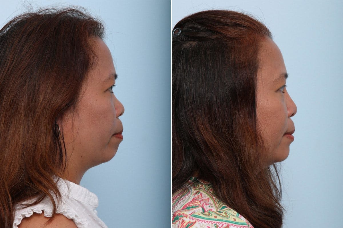 Non-Surgical Rhinoplasty Before & After Gallery - Patient 55171307 - Image 2