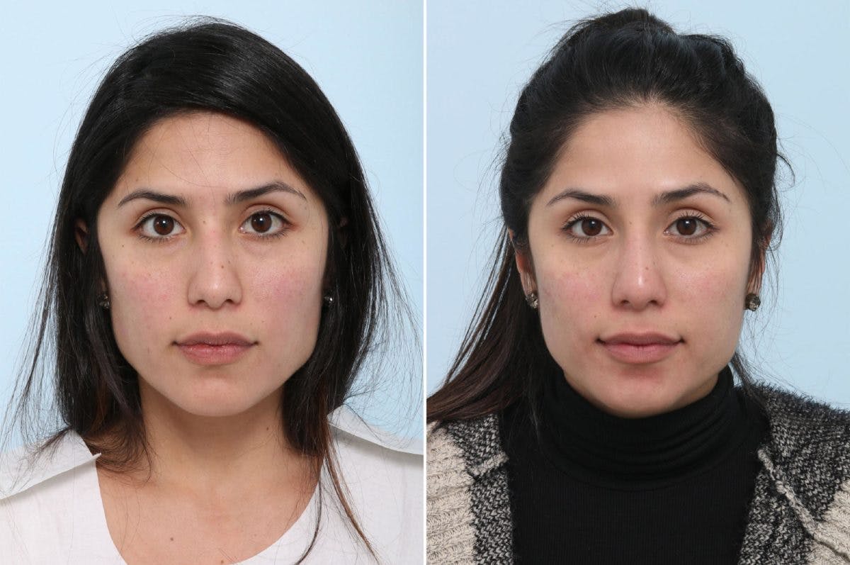 Non-Surgical Rhinoplasty Before & After Gallery - Patient 55171308 - Image 1