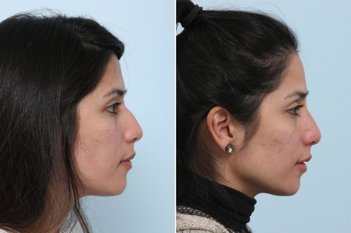 Non-Surgical Rhinoplasty Before & After Gallery - Patient 55171308 - Image 2