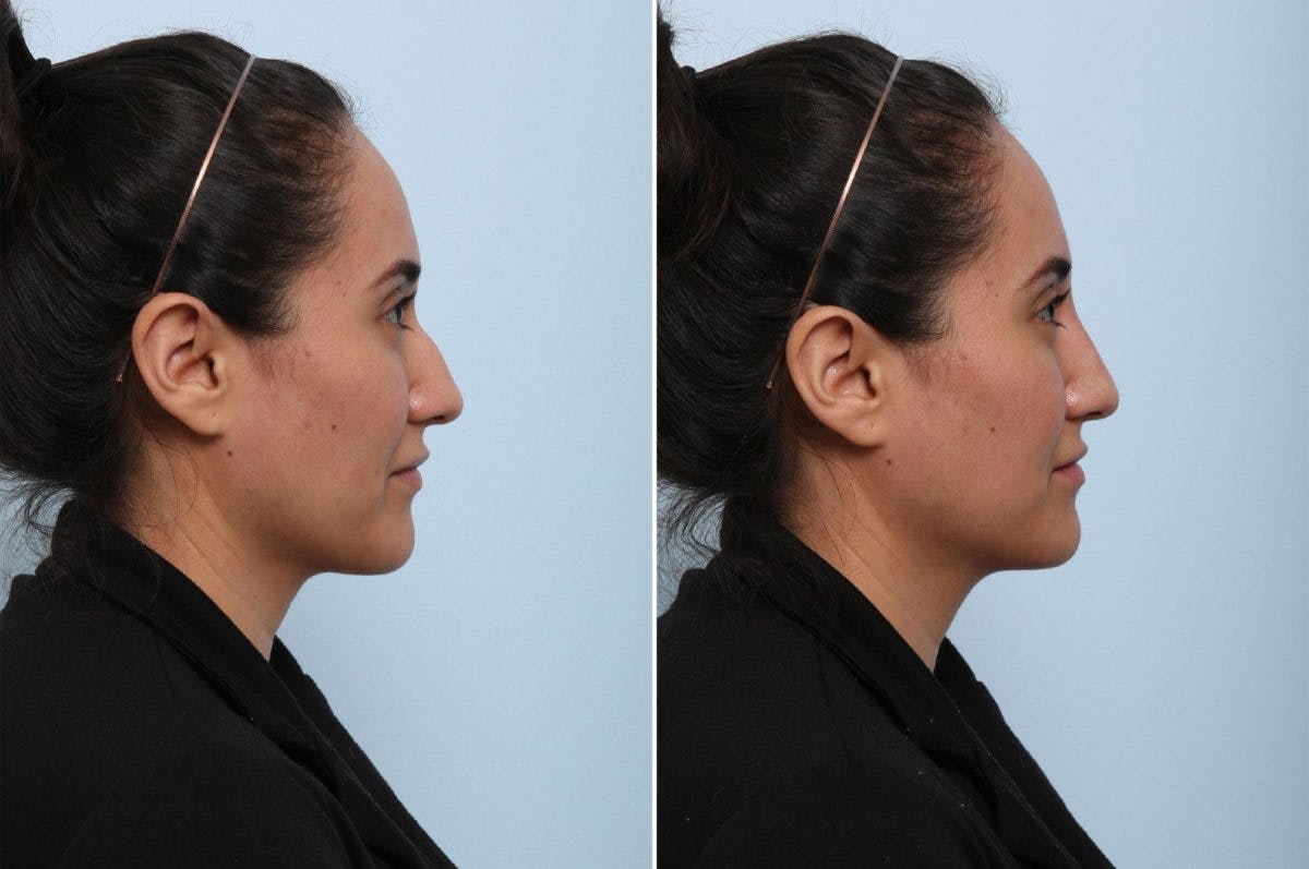 Non-Surgical Rhinoplasty Before & After Gallery - Patient 55171309 - Image 2