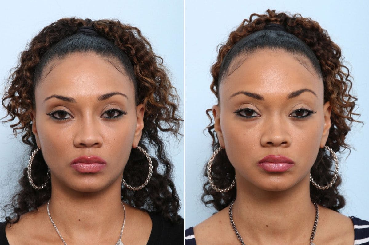 Non-Surgical Rhinoplasty Before & After Gallery - Patient 55171310 - Image 1