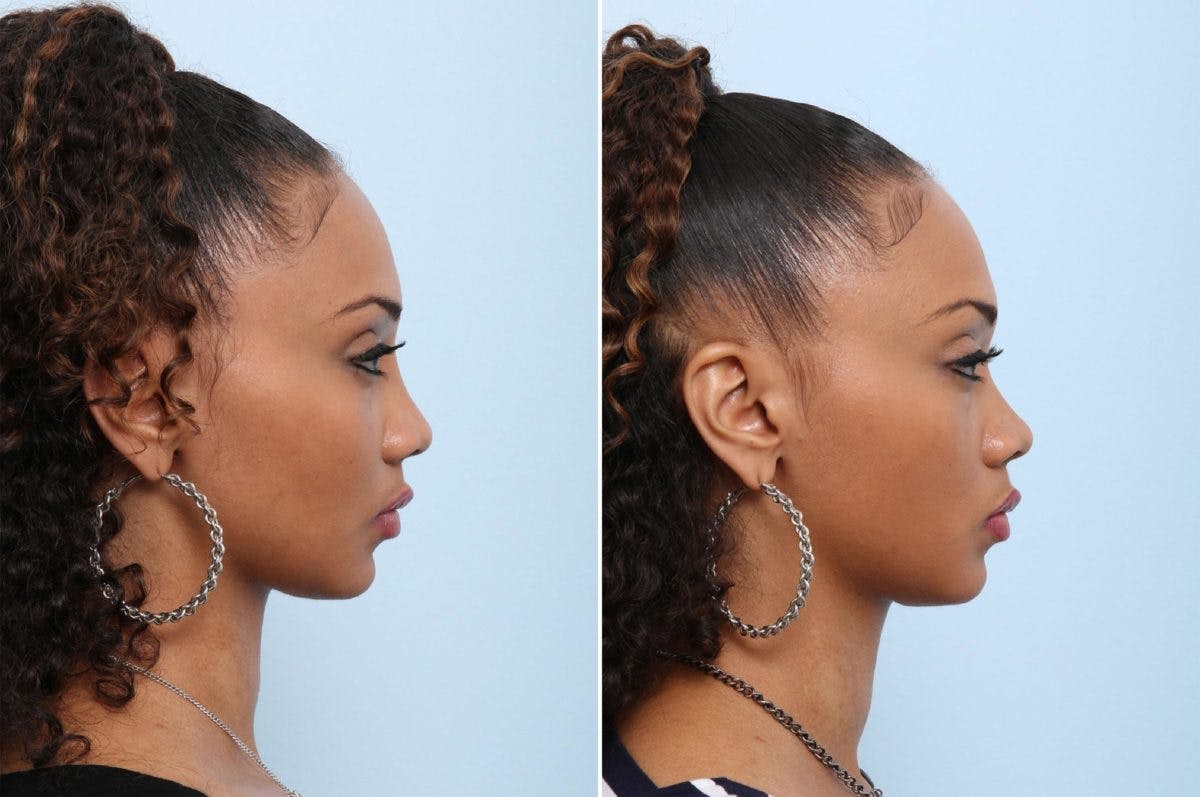 Non-Surgical Rhinoplasty Before & After Gallery - Patient 55171310 - Image 2