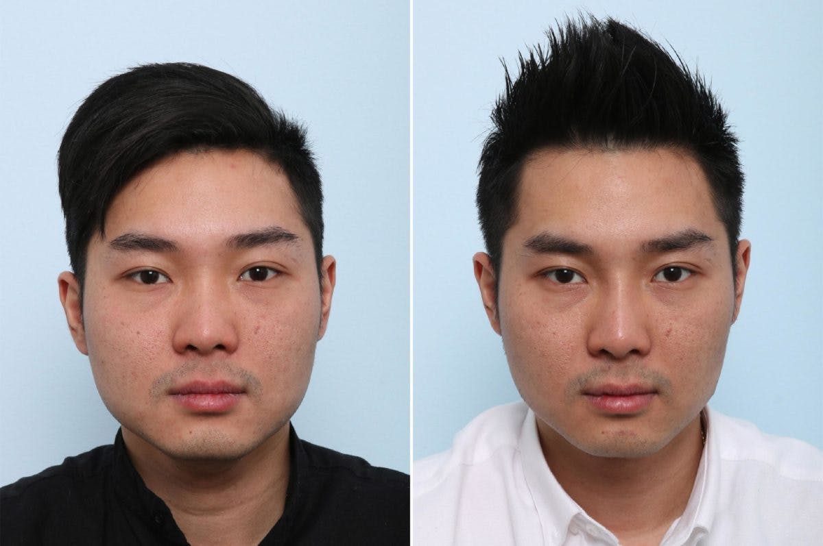 Non-Surgical Rhinoplasty Before & After Gallery - Patient 55176204 - Image 1