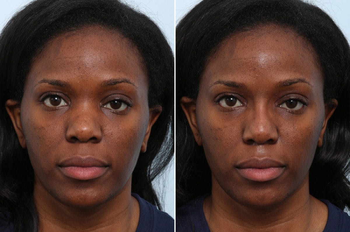 Non-Surgical Rhinoplasty Before & After Gallery - Patient 55176205 - Image 1