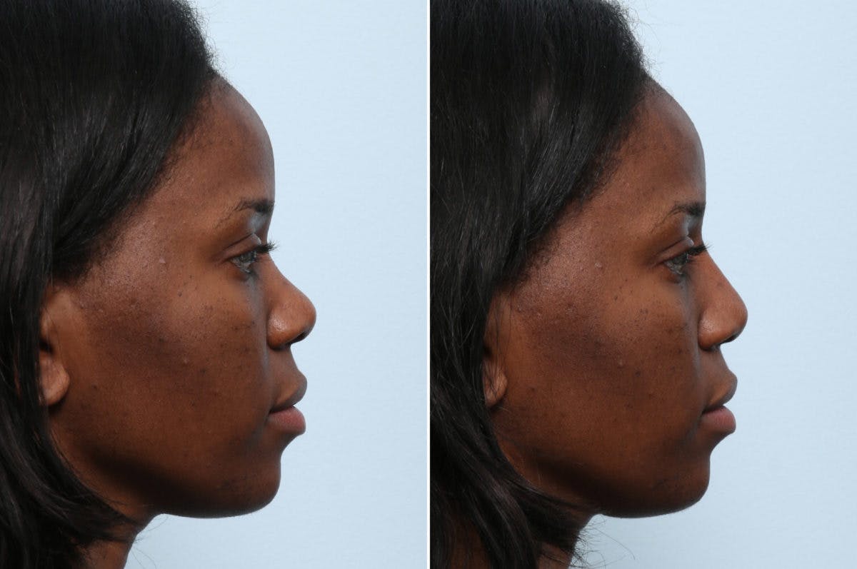 Non-Surgical Rhinoplasty Before & After Gallery - Patient 55176205 - Image 2