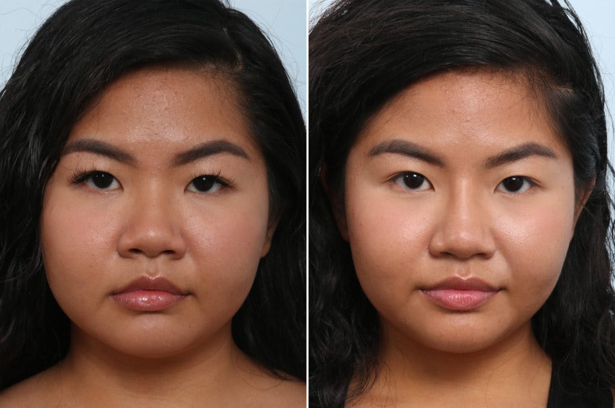 Non-Surgical Rhinoplasty Before & After Photo - Patient 55176206 - Image 1