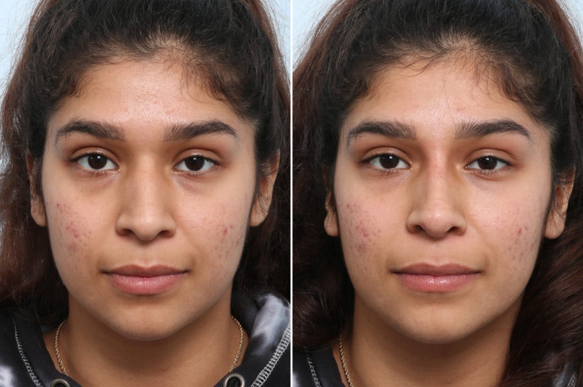 Non-Surgical Rhinoplasty Before & After Gallery - Patient 55176211 - Image 1