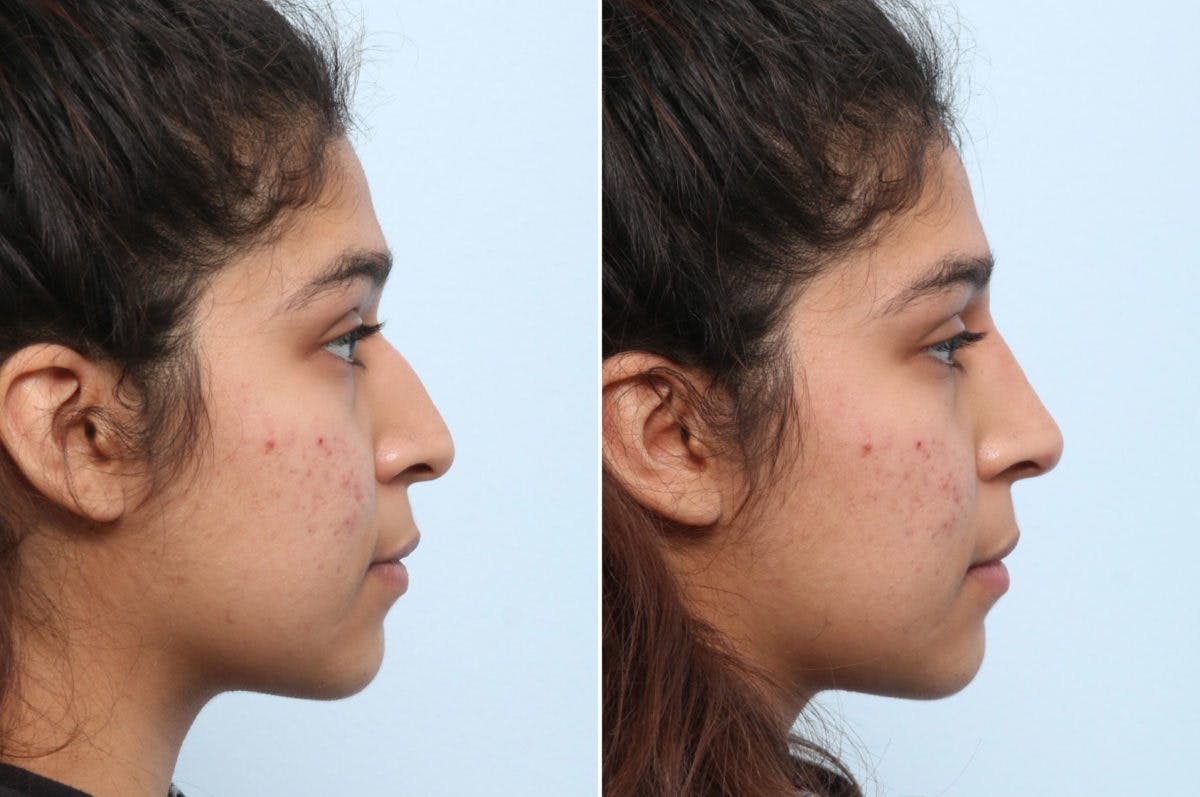 Non-Surgical Rhinoplasty Before & After Gallery - Patient 55176211 - Image 2
