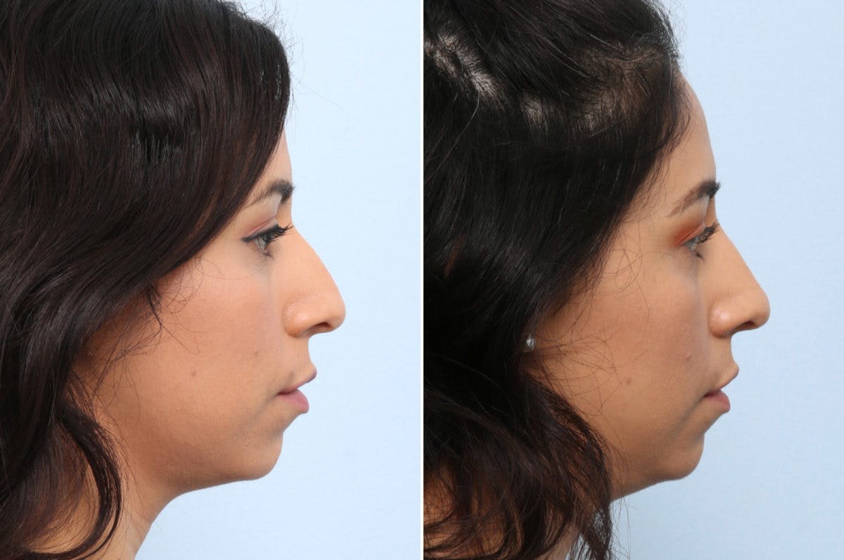 Non-Surgical Rhinoplasty Before & After Gallery - Patient 55176212 - Image 2