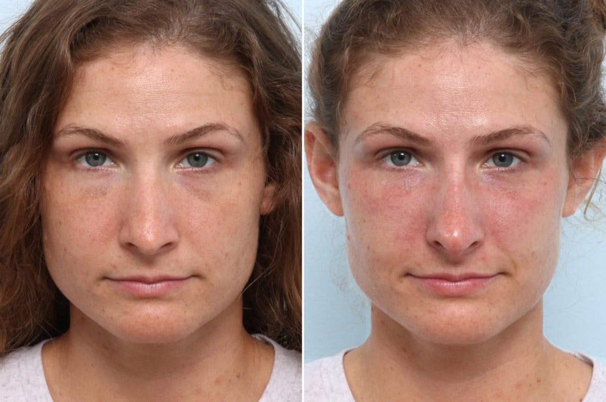 Non-Surgical Rhinoplasty Before & After Gallery - Patient 55176216 - Image 1