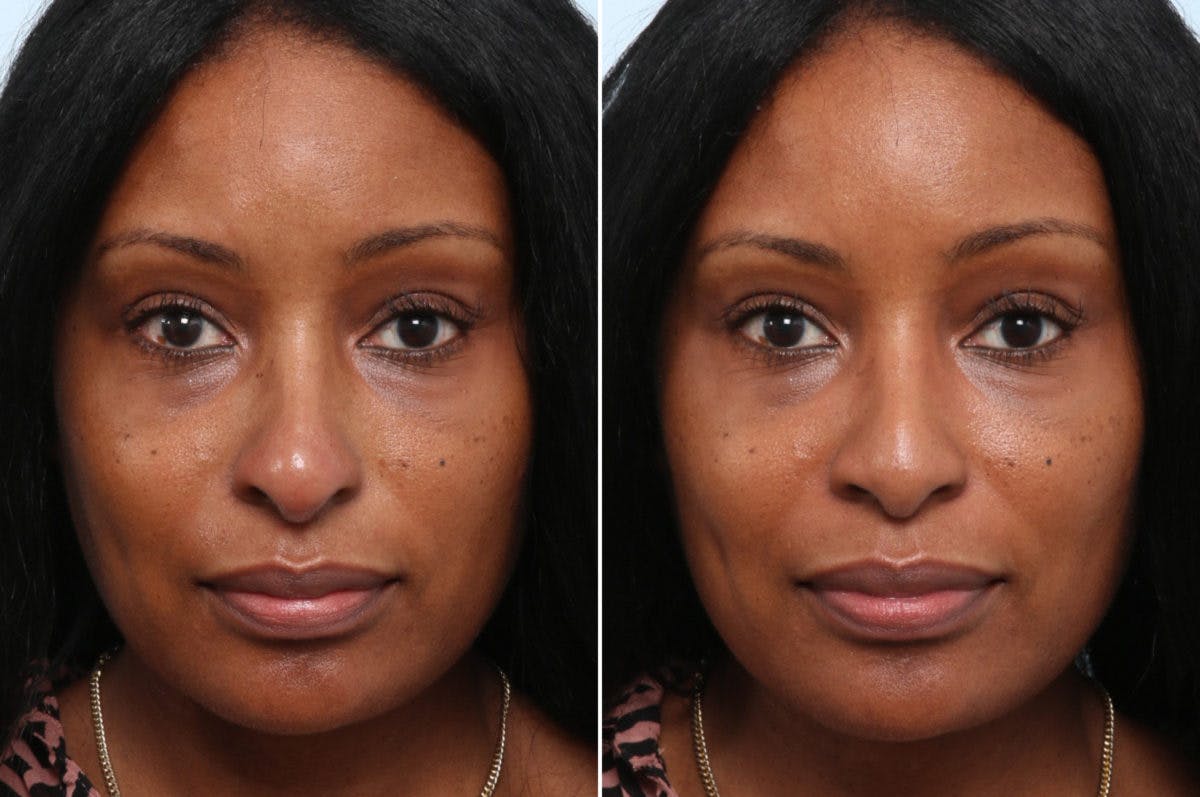 Non-Surgical Rhinoplasty Before & After Gallery - Patient 55176217 - Image 1