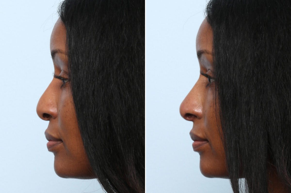 Non-Surgical Rhinoplasty Before & After Gallery - Patient 55176217 - Image 2