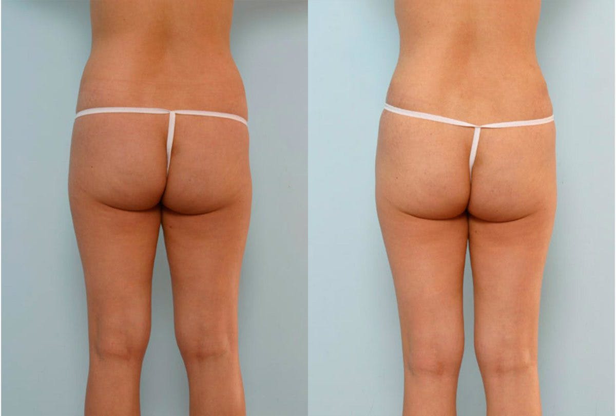 Abdominoplasty Before & After Gallery - Patient 54876294 - Image 4