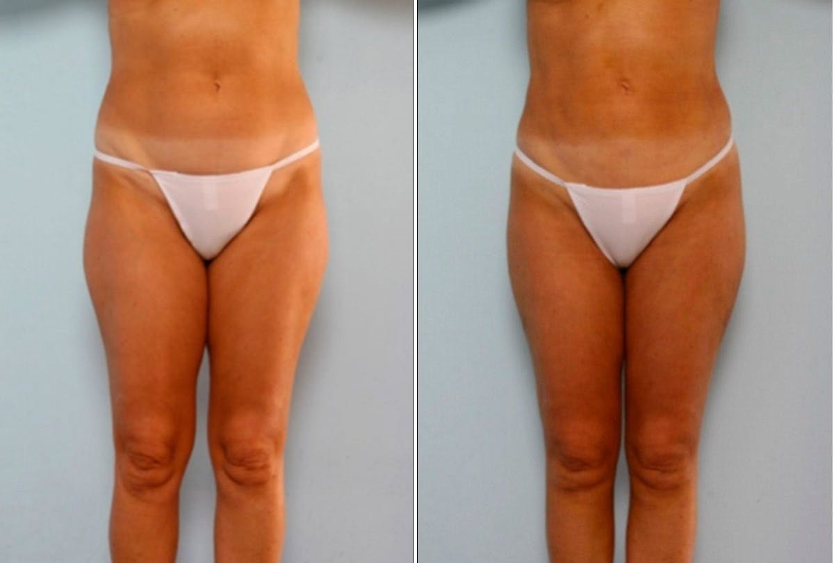 Female Liposuction Before & After Gallery - Patient 54870151 - Image 1