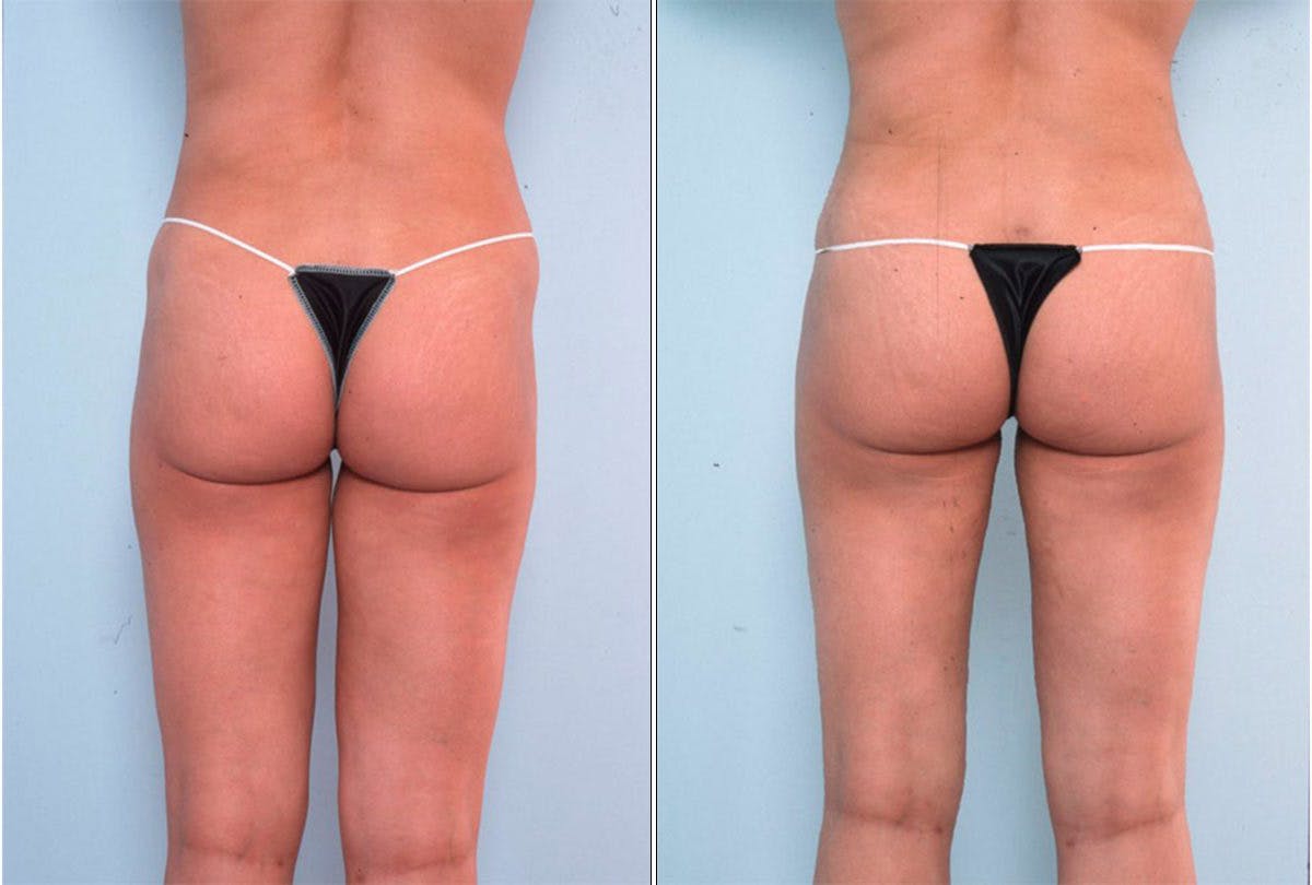 Female Liposuction Before & After Photo - Patient 54870172 - Image 3