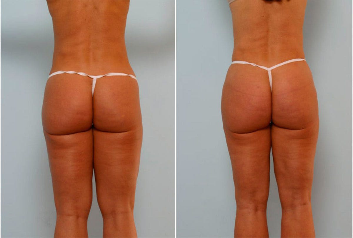 Female Liposuction Before & After Gallery - Patient 54871952 - Image 3