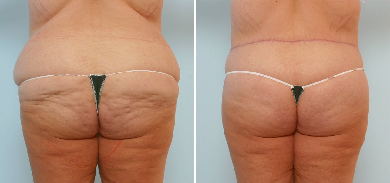 Body Lift Before & After Gallery - Patient 54881952 - Image 4
