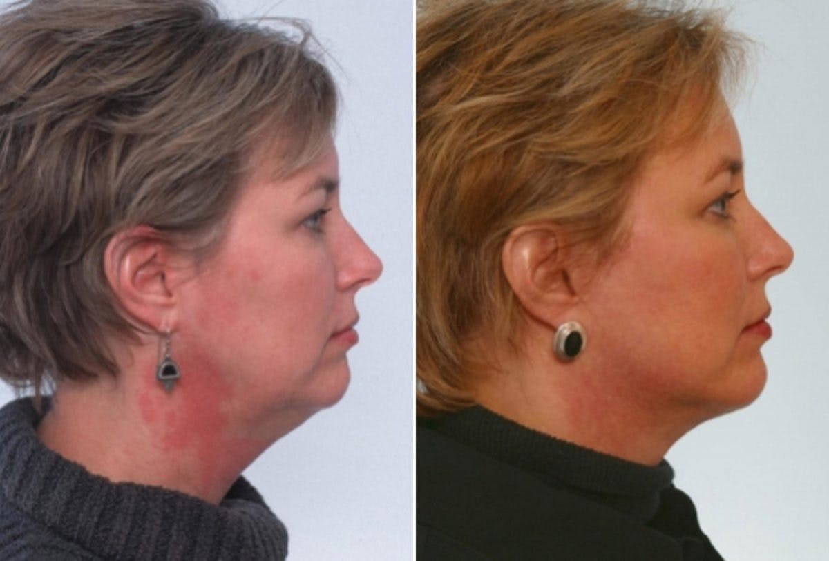 Facelift Before & After Gallery - Patient 55609233 - Image 3