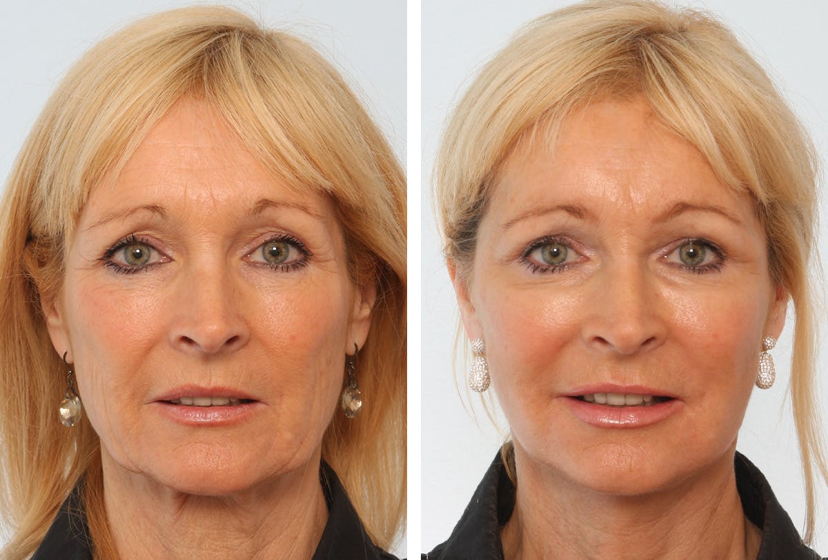 Facelift Before & After Gallery - Patient 55936982 - Image 1