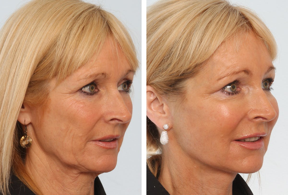 Facelift Before & After Gallery - Patient 55936982 - Image 2