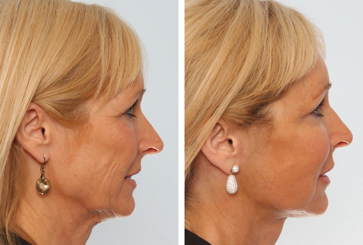 Facelift Before & After Gallery - Patient 55936982 - Image 3