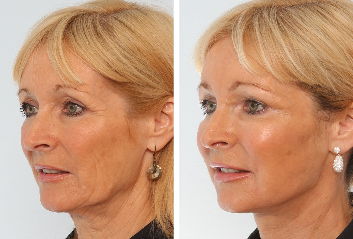 Facelift Before & After Gallery - Patient 55936982 - Image 4