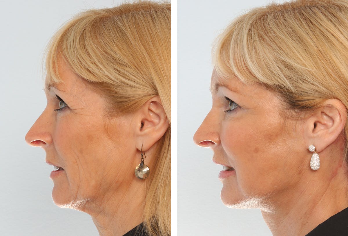 Facelift Before & After Gallery - Patient 55936982 - Image 5
