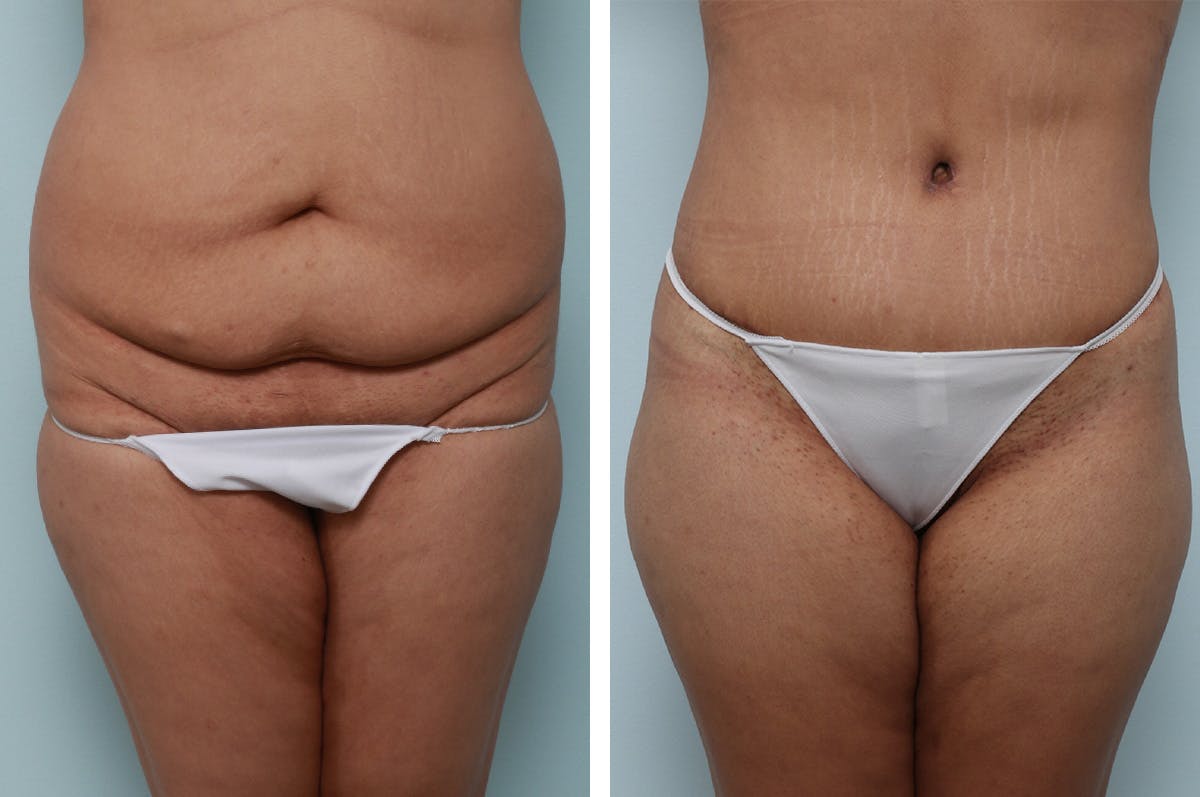 Body Lift Before & After Gallery - Patient 55982157 - Image 1