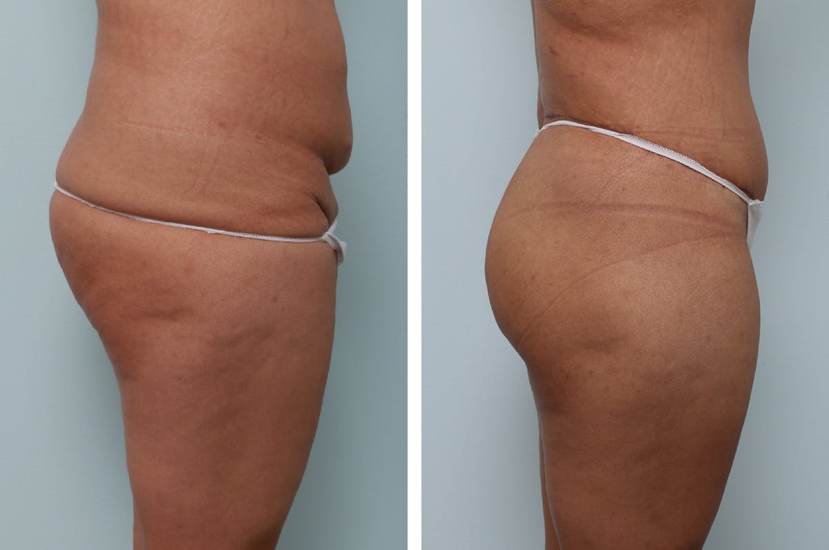 Body Lift Before & After Gallery - Patient 55982157 - Image 2